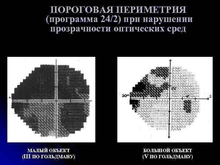 Компьютерная периметрия