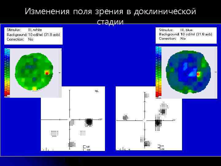 Изменения поля зрения в доклинической стадии 