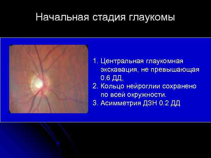 Начальная стадия глаукомы 1. Центральная глаукомная экскавация, не превышающая 0. 6 ДД, 2. Кольцо
