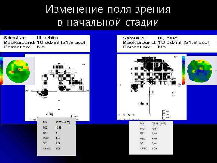 Изменение поля зрения в начальной стадии 