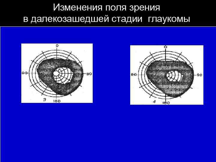 Как изменяется поле зрения