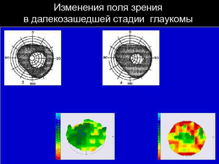 Изменения поля зрения в далекозашедшей стадии глаукомы 