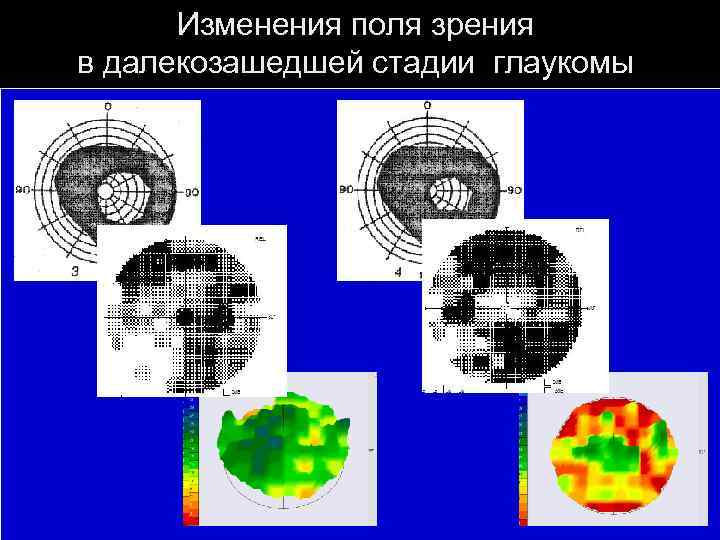 Изменения поля зрения в далекозашедшей стадии глаукомы 