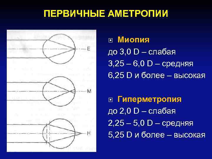 ПЕРВИЧНЫЕ АМЕТРОПИИ Миопия до 3, 0 D – слабая 3, 25 – 6, 0