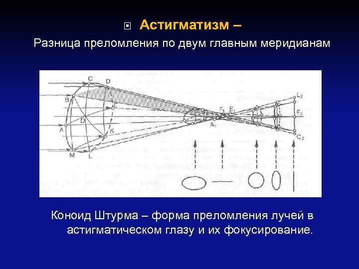  Астигматизм – Разница преломления по двум главным меридианам Коноид Штурма – форма преломления