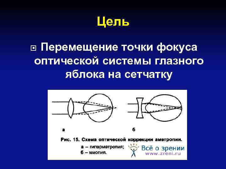 Цель Перемещение точки фокуса оптической системы глазного яблока на сетчатку 