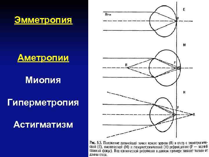 Расположение изображения предмета при дальнозоркости