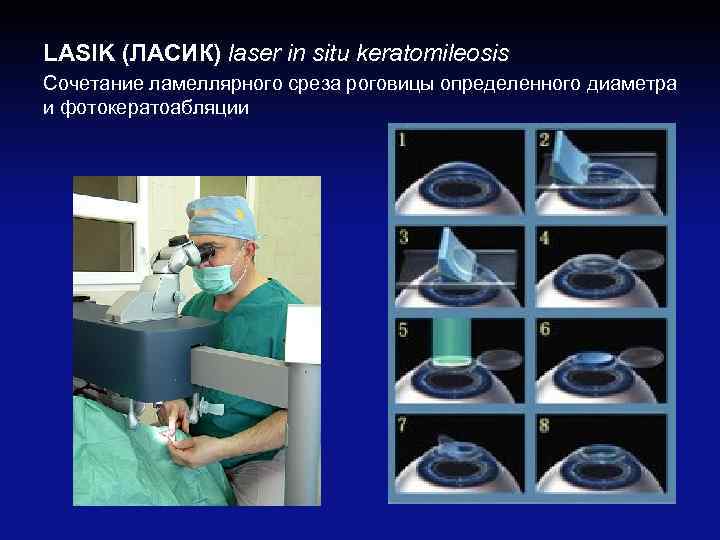 LASIK (ЛАСИК) laser in situ keratomileosis Cочетание ламеллярного среза роговицы определенного диаметра и фотокератоабляции