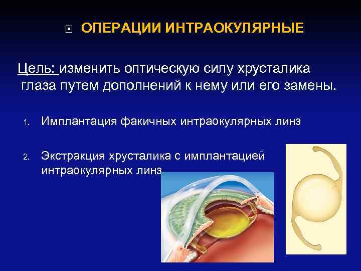  ОПЕРАЦИИ ИНТРАОКУЛЯРНЫЕ Цель: изменить оптическую силу хрусталика глаза путем дополнений к нему или