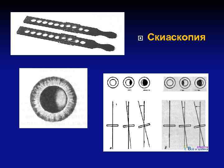  Скиаскопия 