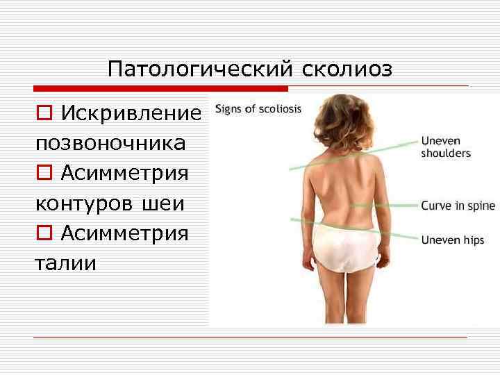 Патологический сколиоз o Искривление позвоночника o Асимметрия контуров шеи o Асимметрия талии 