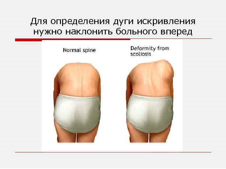 Для определения дуги искривления нужно наклонить больного вперед 