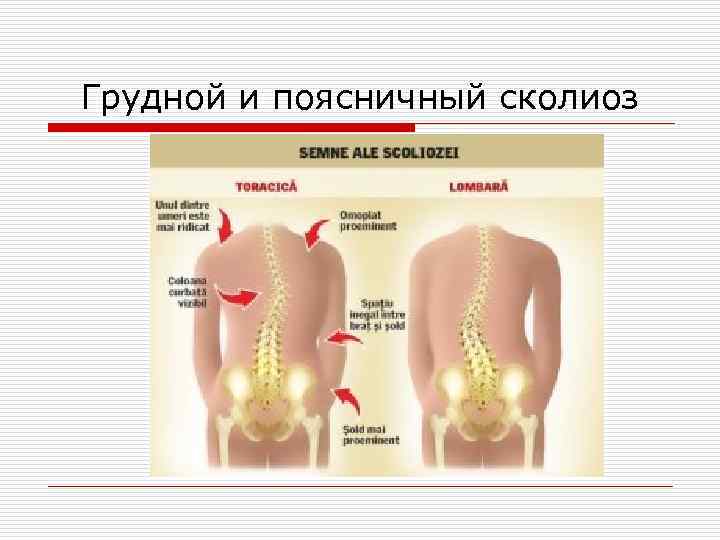Грудной и поясничный сколиоз 