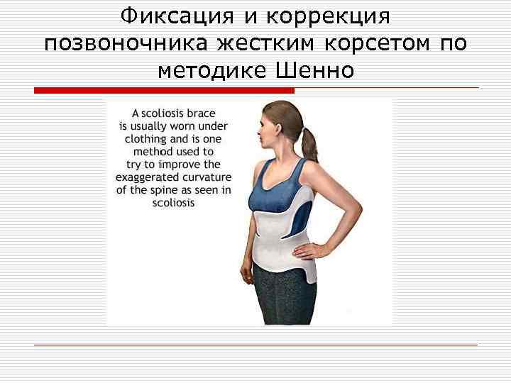 Фиксация и коррекция позвоночника жестким корсетом по методике Шенно 