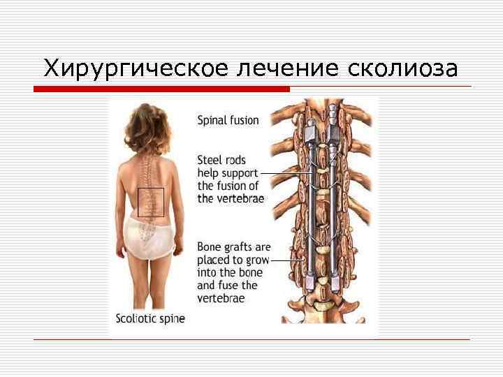 Хирургическое лечение сколиоза 
