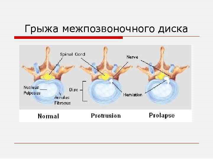 Грыжа межпозвоночного диска 