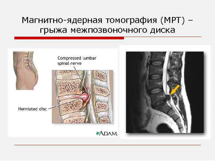 Магнитно-ядернaя томография (МРТ) – грыжа межпозвоночного диска 