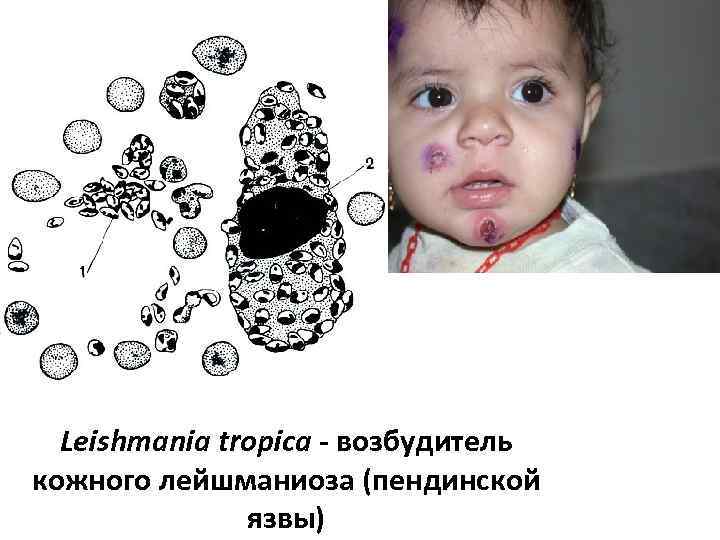 Leishmania tropica - возбудитель кожного лейшманиоза (пендинской язвы) 