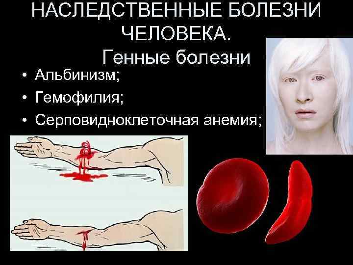 НАСЛЕДСТВЕННЫЕ БОЛЕЗНИ ЧЕЛОВЕКА. Генные болезни • Альбинизм; • Гемофилия; • Серповидноклеточная анемия; 