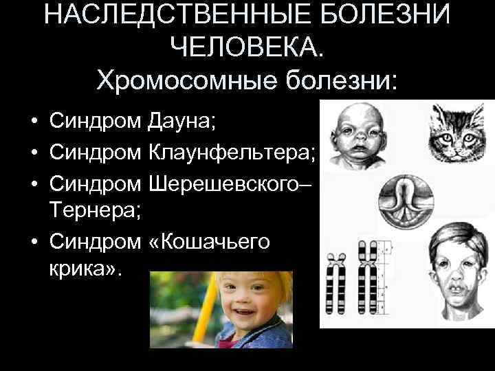 НАСЛЕДСТВЕННЫЕ БОЛЕЗНИ ЧЕЛОВЕКА. Хромосомные болезни: • Синдром Дауна; • Синдром Клаунфельтера; • Синдром Шерешевского–