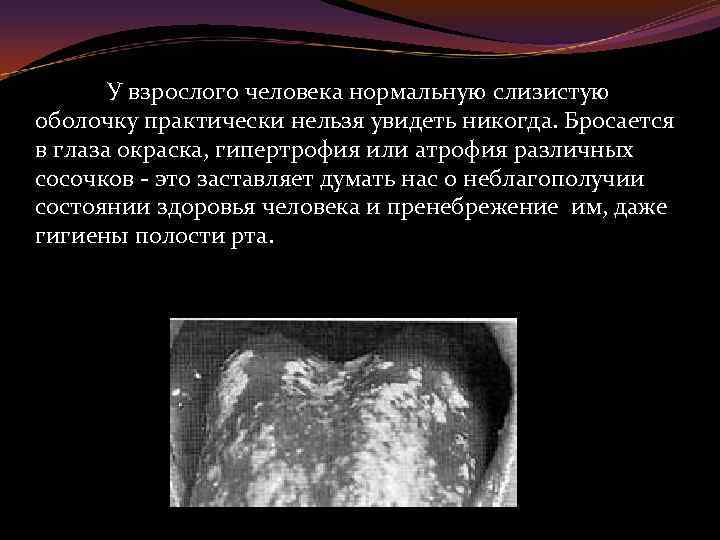 У взрослого человека нормальную слизистую оболочку практически нельзя увидеть никогда. Бросается в глаза окраска,