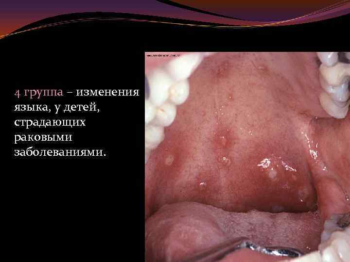 4 группа – изменения языка, у детей, страдающих раковыми заболеваниями. 