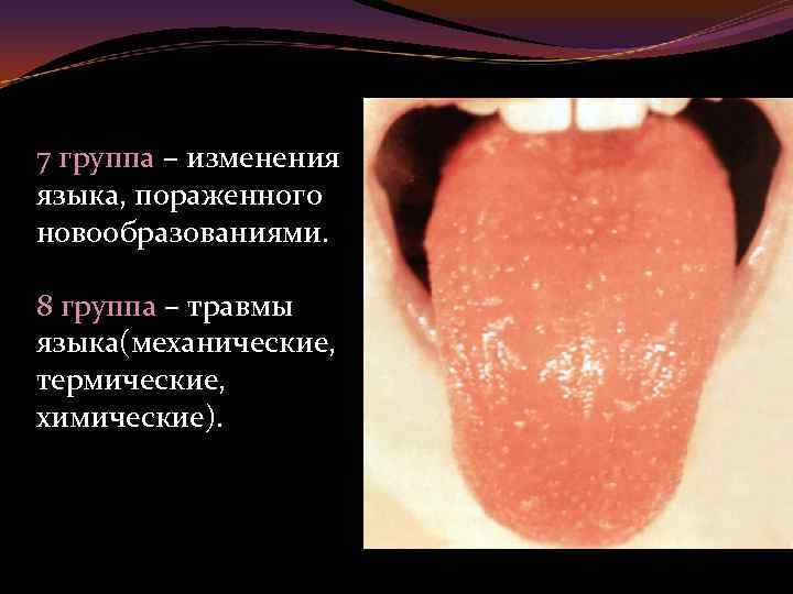 7 группа – изменения языка, пораженного новообразованиями. 8 группа – травмы языка(механические, термические, химические).