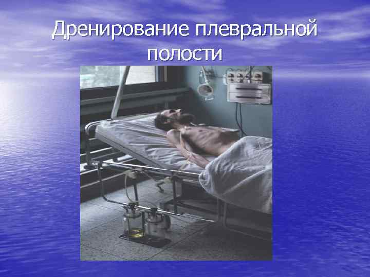 Дренирование плевральной полости 