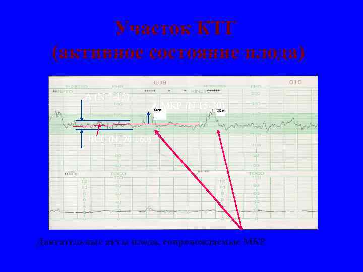 Участок КТГ (активное состояние плода) А (N 7 -15) А МКР (N 15 -30)
