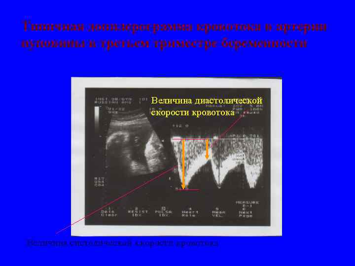Типичная допплерограмма кровотока в артерии пуповины в третьем триместре беременности Величина диастолической скорости кровотока