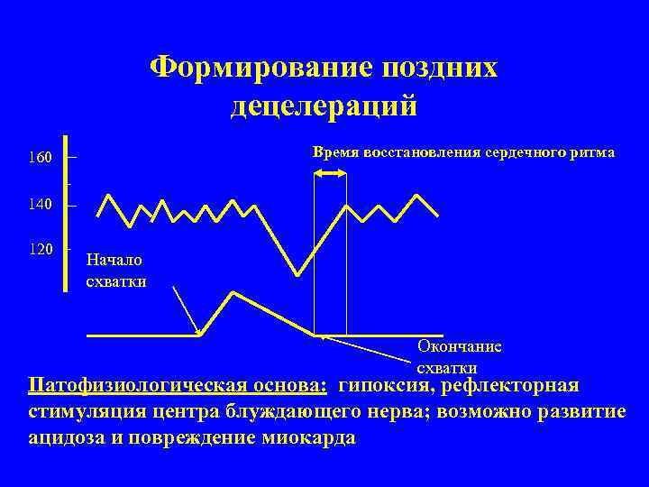 Формирование поздних децелераций Время восстановления сердечного ритма 160 140 120 Начало схватки Окончание схватки