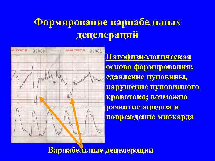 Формирование вариабельных децелераций Патофизиологическая основа формирования: сдавление пуповины, нарушение пуповинного кровотока; возможно развитие ацидоза