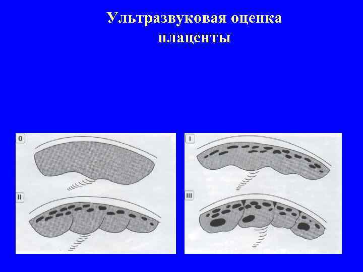 Ультразвуковая оценка плаценты - определение локализации плаценты - измерение толщины плаценты - определение степени