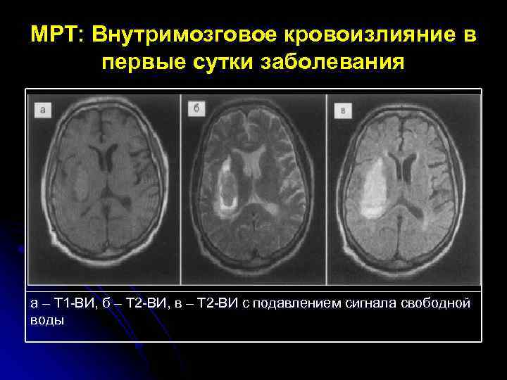 МРТ: Внутримозговое кровоизлияние в первые сутки заболевания а – Т 1 -ВИ, б –