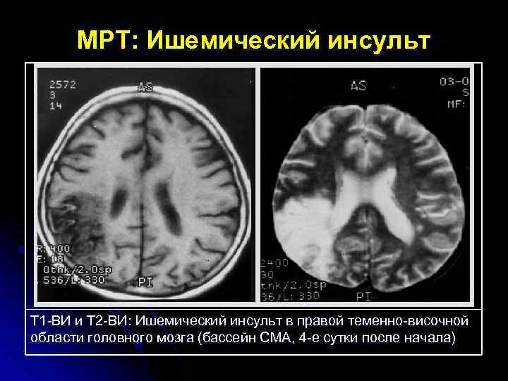 МРТ: Ишемический инсульт Т 1 -ВИ и Т 2 -ВИ: Ишемический инсульт в правой