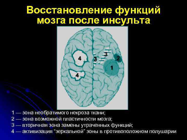 Восстановление функций мозга после инсульта 1 — зона необратимого некроза ткани; 2 — зона