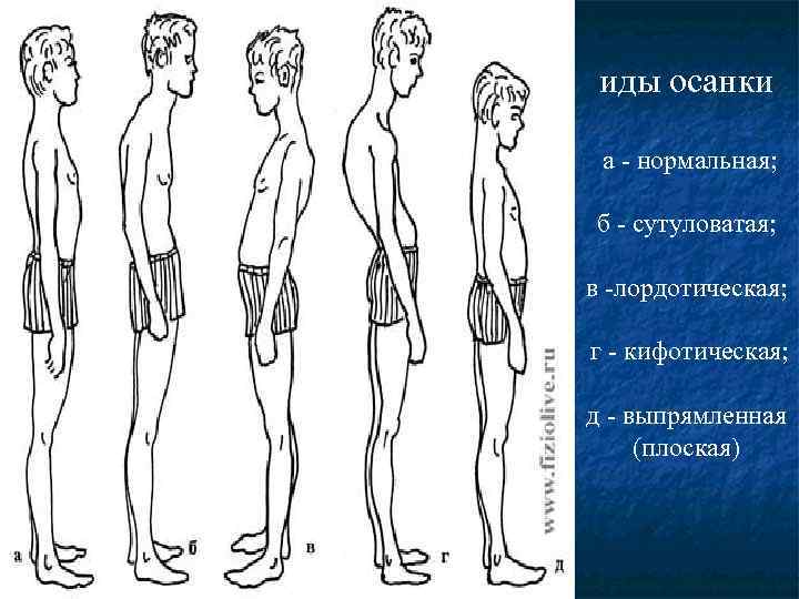 иды осанки а - нормальная; б - сутуловатая; в -лордотическая; г - кифотическая; д