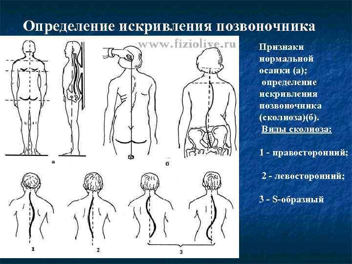 Плоскостопие искривление позвоночника. Типы искривления позвоночника. Сколиоз позвоночника измерения. Искривление позвоночника конспект. 3 Типа искривления позвоночника.