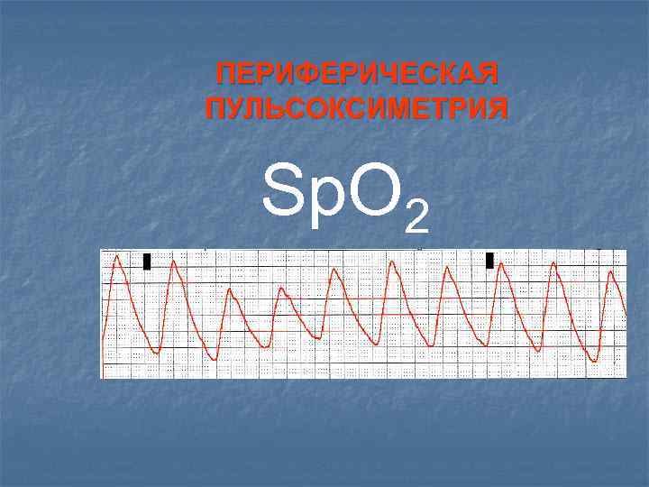ПЕРИФЕРИЧЕСКАЯ ПУЛЬСОКСИМЕТРИЯ Sp. O 2 