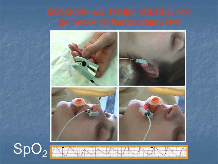 ВОЗМОЖНЫЕ ТОЧКИ КРЕПЛЕНИЯ ДАТЧИКА ПУЛЬСОКСИМЕТРА Sp. O 2 