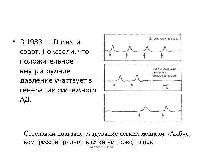  • В 1983 г J. Ducas и соавт. Показали, что положительное внутригрудное давление