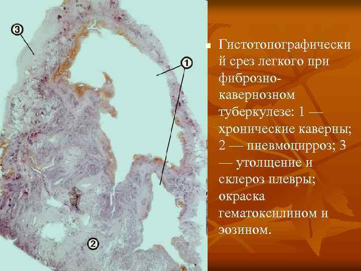 n Гистотопографически й срез легкого при фибрознокавернозном туберкулезе: 1 — хронические каверны; 2 —