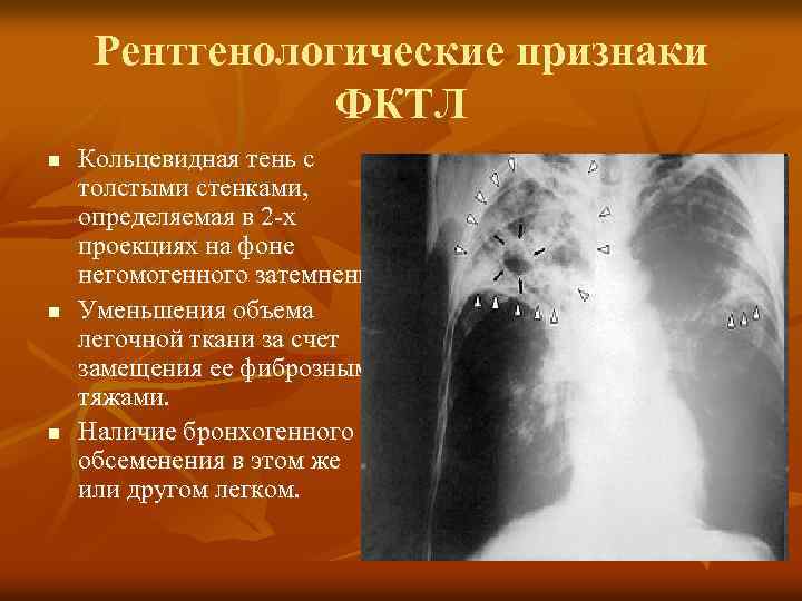 Рентгенологические признаки ФКТЛ n n n Кольцевидная тень с толстыми стенками, определяемая в 2