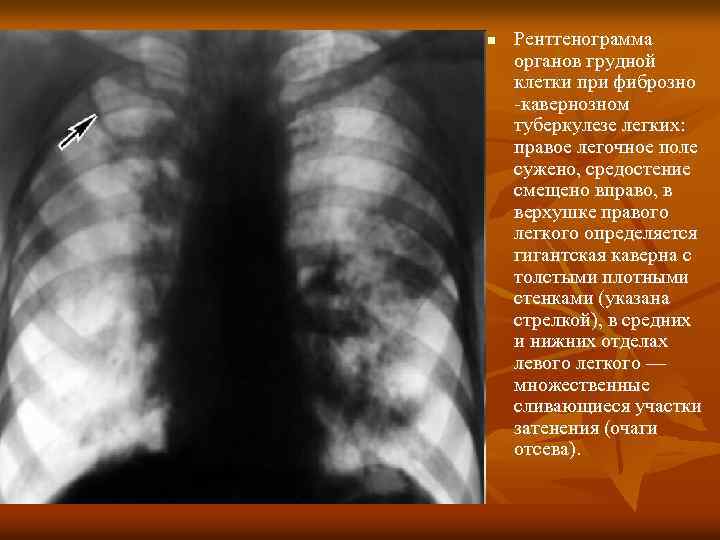 n Рентгенограмма органов грудной клетки при фиброзно -кавернозном туберкулезе легких: правое легочное поле сужено,