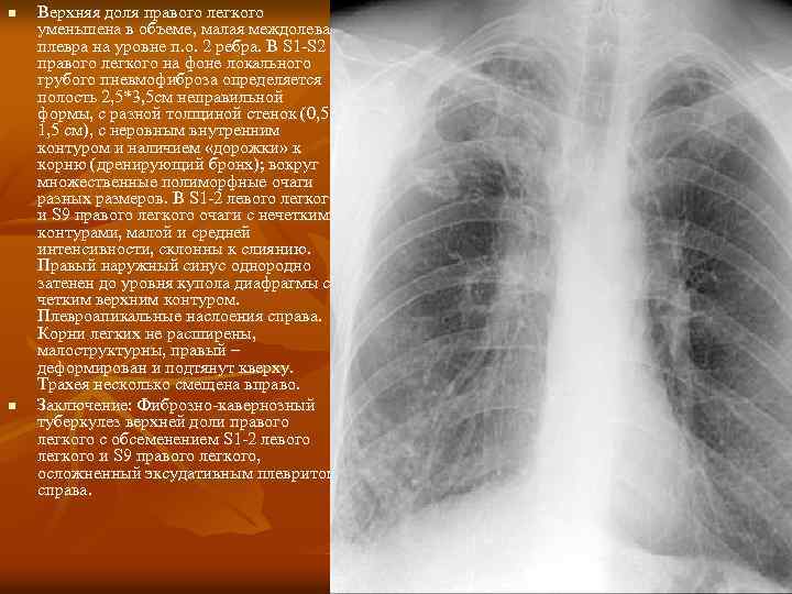 n n Верхняя доля правого легкого уменьшена в объеме, малая междолевая плевра на уровне