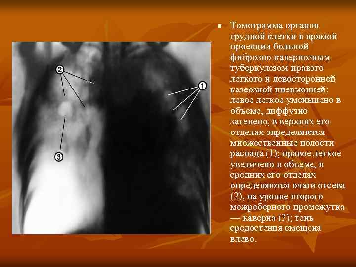 n Томограмма органов грудной клетки в прямой проекции больной фиброзно-кавернозным туберкулезом правого легкого и