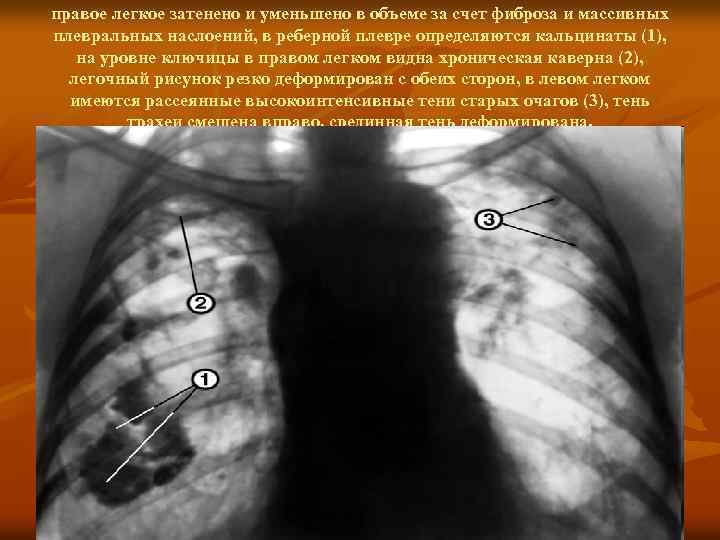 правое легкое затенено и уменьшено в объеме за счет фиброза и массивных плевральных наслоений,