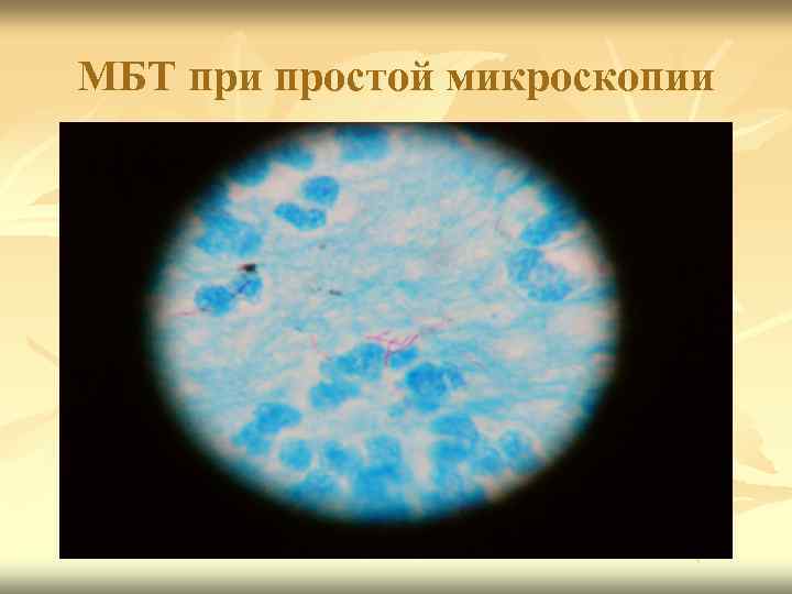 МБТ при простой микроскопии 