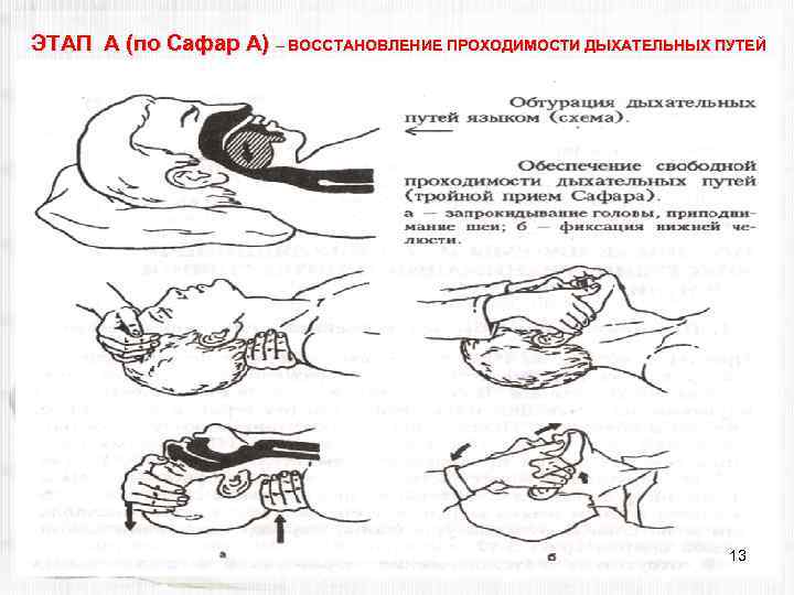 ЭТАП А (по Сафар А) – ВОССТАНОВЛЕНИЕ ПРОХОДИМОСТИ ДЫХАТЕЛЬНЫХ ПУТЕЙ 13 