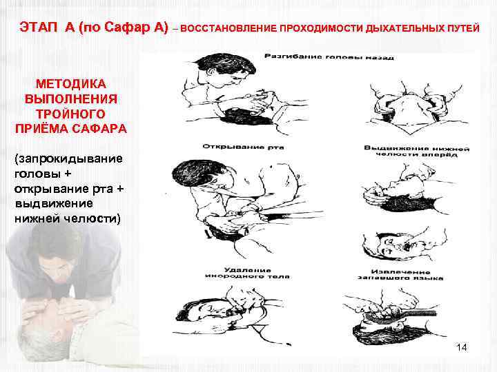 ЭТАП А (по Сафар А) – ВОССТАНОВЛЕНИЕ ПРОХОДИМОСТИ ДЫХАТЕЛЬНЫХ ПУТЕЙ МЕТОДИКА ВЫПОЛНЕНИЯ ТРОЙНОГО ПРИЁМА